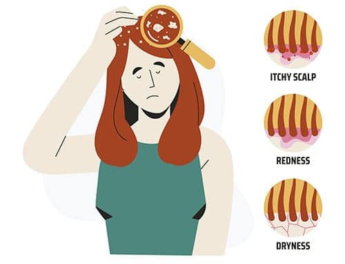 Causes of Scalp Psoriasis
