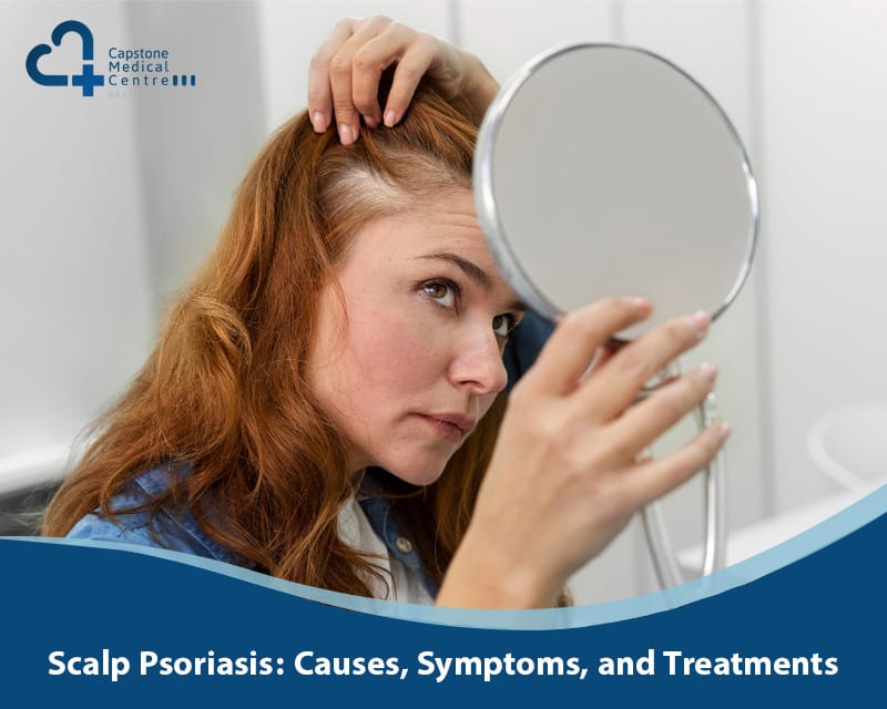 Scalp Psoriasis: Causes, Symptoms, and Effective Treatments